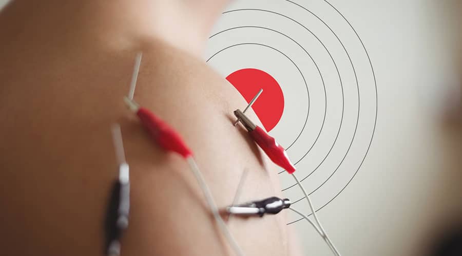 الکترواکوپانکچر یا electroacupuncture