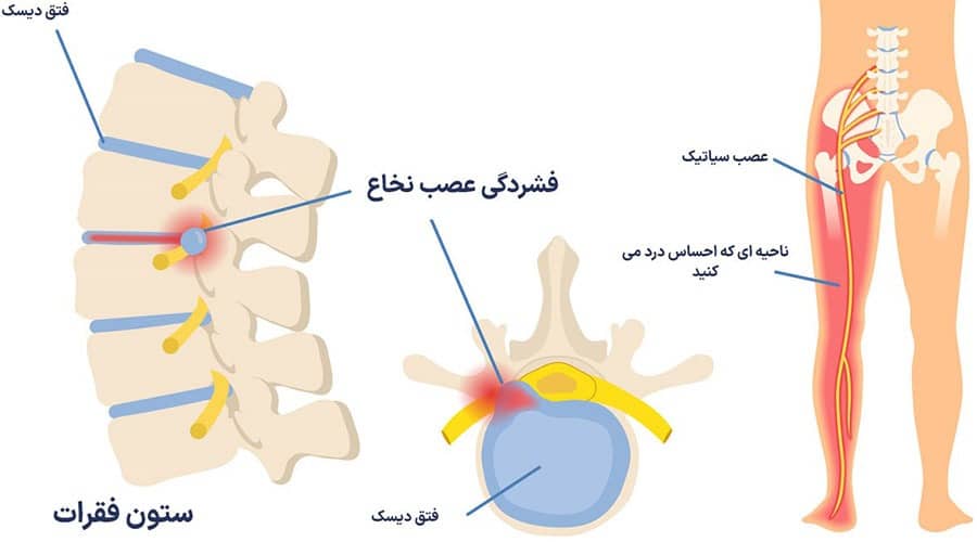 رابطه بین دیسک کمر و سیاتیک The relationship between lumbar disc and sciatica