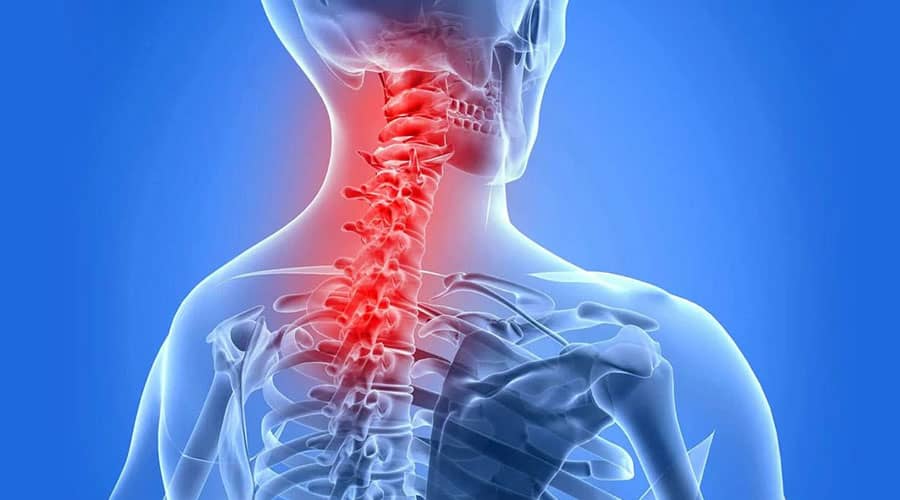 درمان آرتروز گردن Treatment of neck arthritis